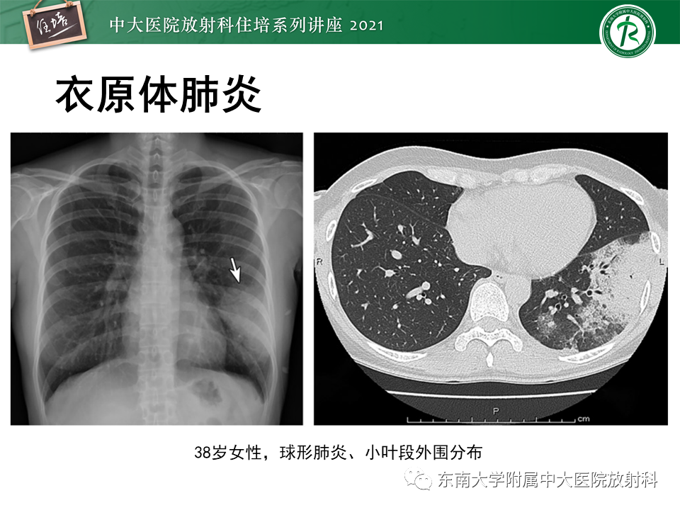 影像PPT - 【PPT】非典型肺炎及其重症病例的影像表现-12