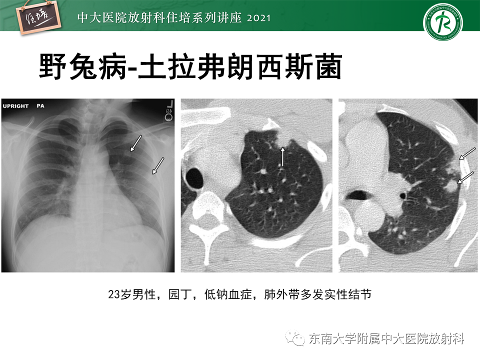 影像PPT - 【PPT】非典型肺炎及其重症病例的影像表现-15
