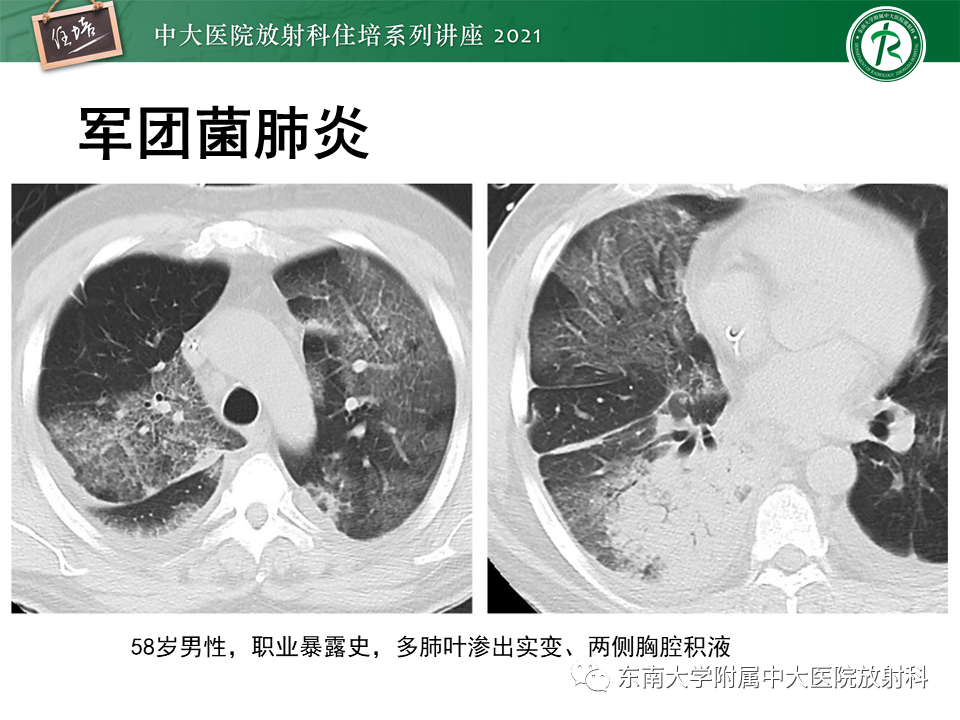 影像PPT - 【PPT】非典型肺炎及其重症病例的影像表现-13
