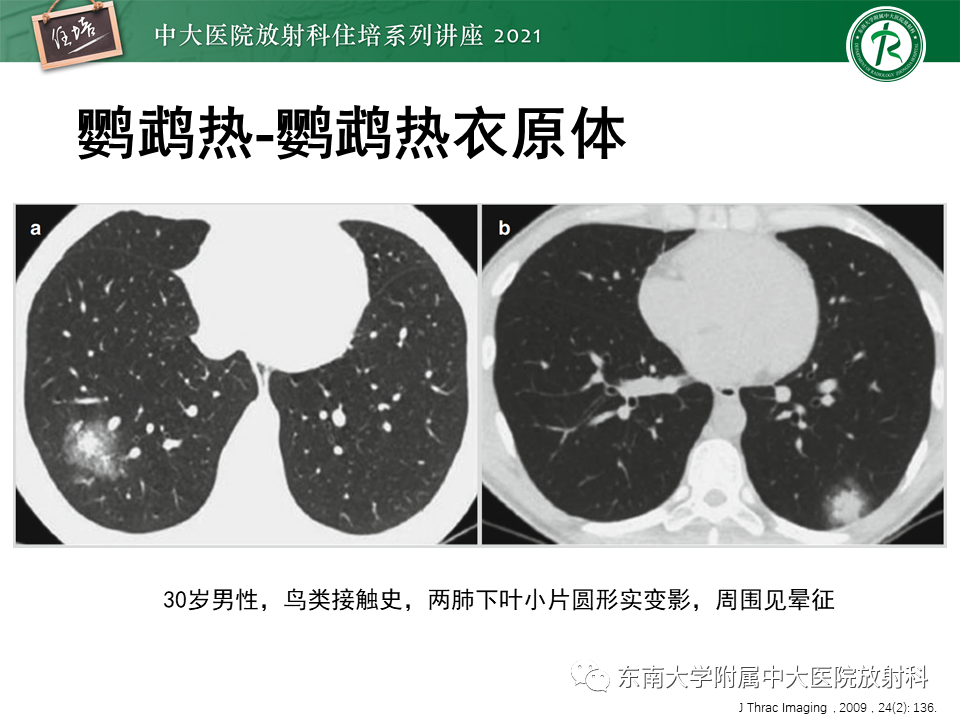 影像PPT - 【PPT】非典型肺炎及其重症病例的影像表现-14