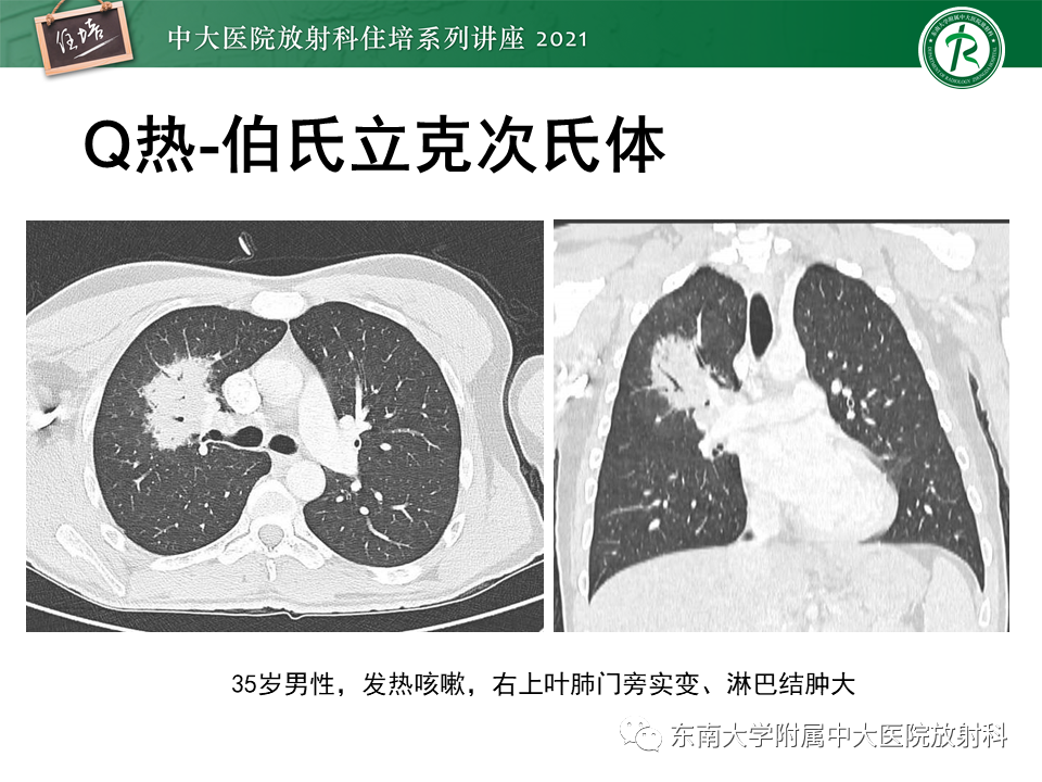 影像PPT - 【PPT】非典型肺炎及其重症病例的影像表现-16