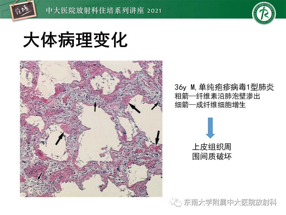 影像PPT - 【PPT】非典型肺炎及其重症病例的影像表现-23