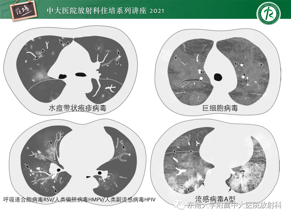 影像PPT - 【PPT】非典型肺炎及其重症病例的影像表现-26