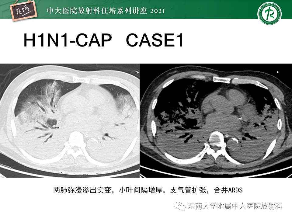 影像PPT - 【PPT】非典型肺炎及其重症病例的影像表现-29
