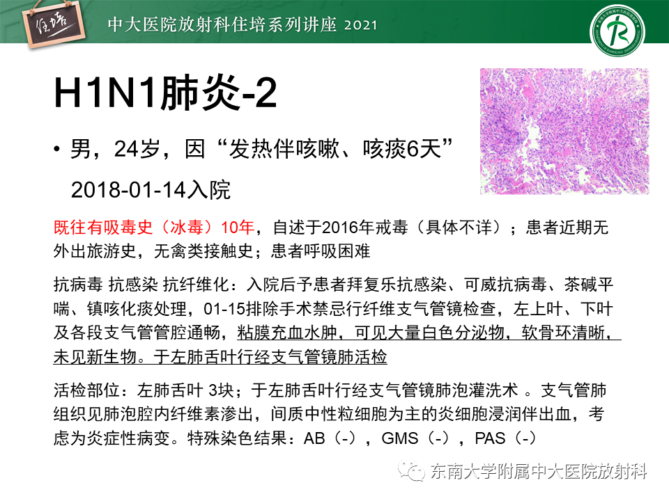 影像PPT - 【PPT】非典型肺炎及其重症病例的影像表现-30