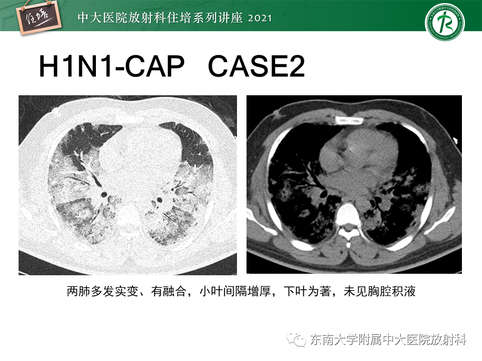 影像PPT - 【PPT】非典型肺炎及其重症病例的影像表现-31