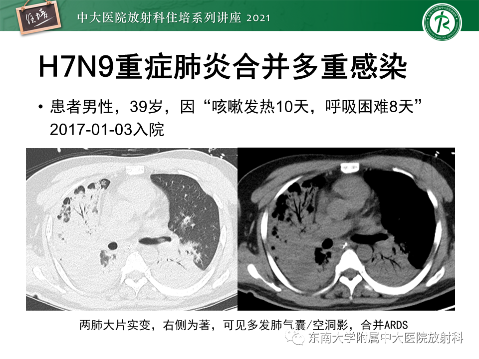 影像PPT - 【PPT】非典型肺炎及其重症病例的影像表现-33