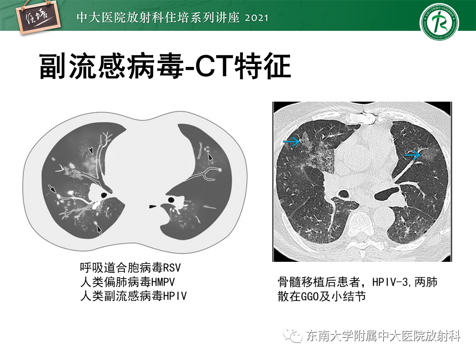 影像PPT - 【PPT】非典型肺炎及其重症病例的影像表现-34