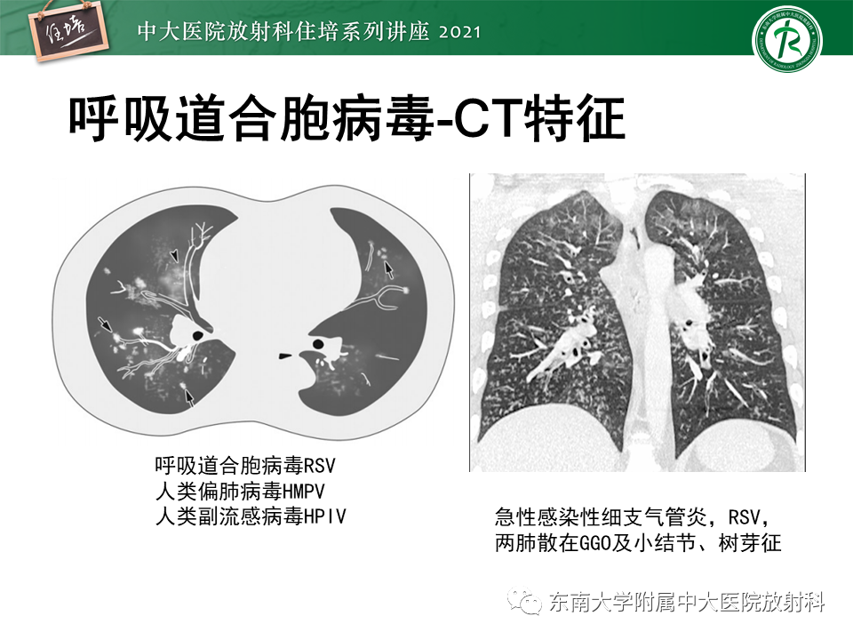 影像PPT - 【PPT】非典型肺炎及其重症病例的影像表现-35
