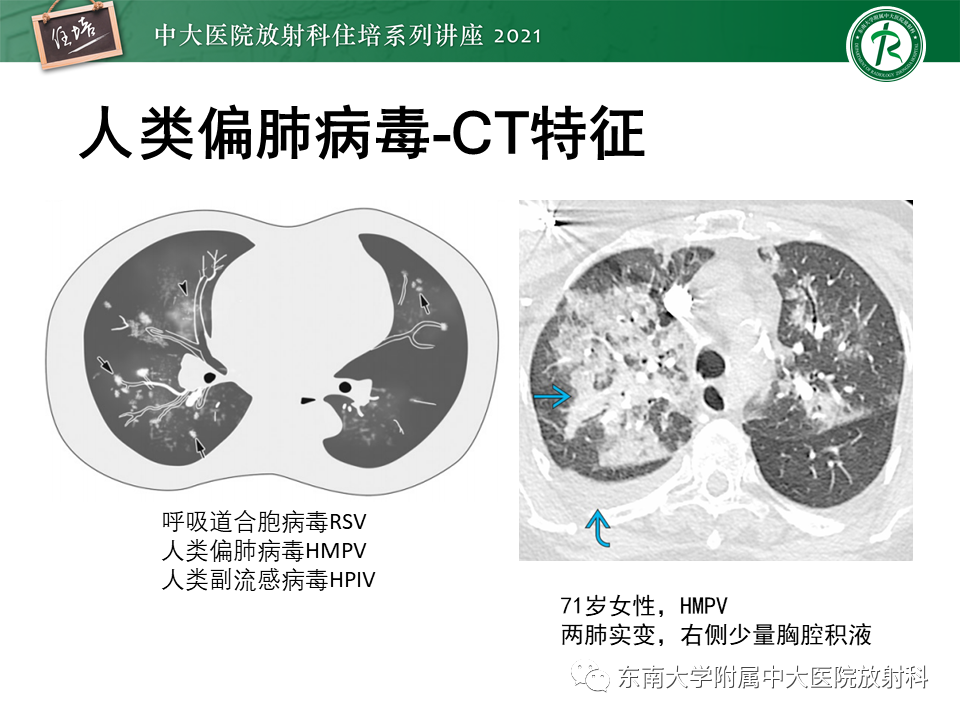 影像PPT - 【PPT】非典型肺炎及其重症病例的影像表现-36