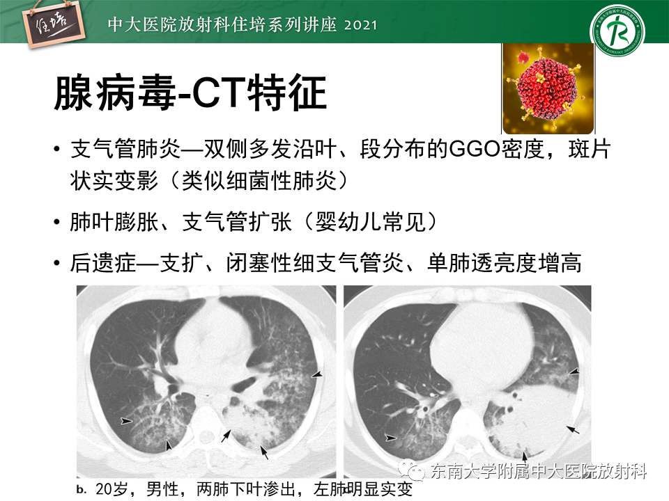 影像PPT - 【PPT】非典型肺炎及其重症病例的影像表现-37