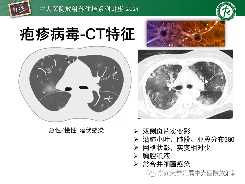 影像PPT - 【PPT】非典型肺炎及其重症病例的影像表现-38