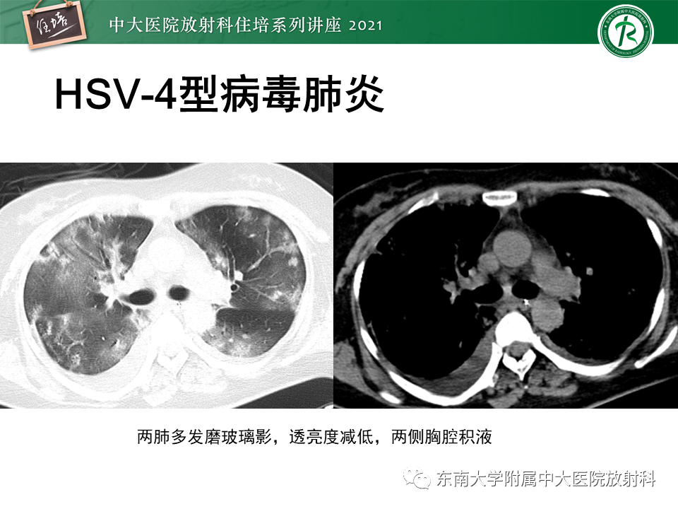 影像PPT - 【PPT】非典型肺炎及其重症病例的影像表现-40