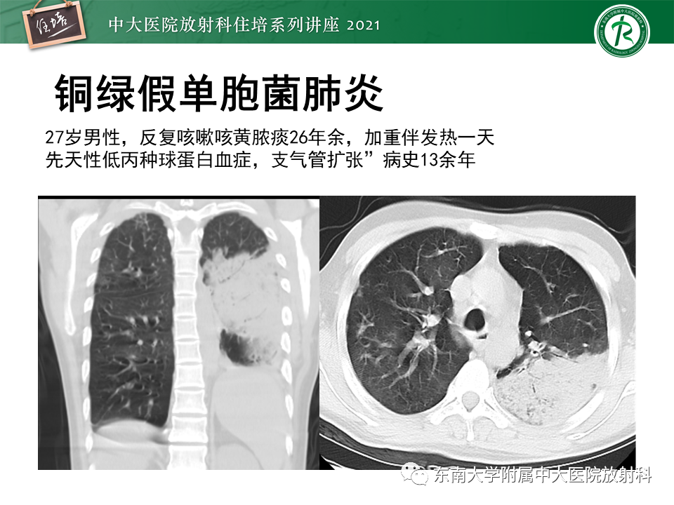 影像PPT - 【PPT】非典型肺炎及其重症病例的影像表现-42