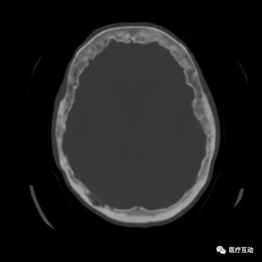 影像PPT - 颅骨增厚影像表现-2 影像PPT - 颅骨增厚影像表现-2