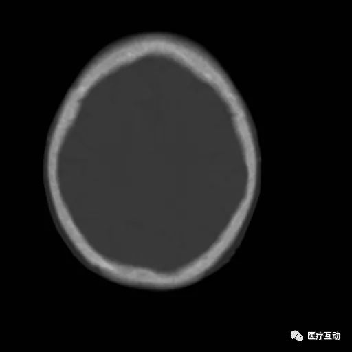 影像PPT - 颅骨增厚影像表现-4 影像PPT - 颅骨增厚影像表现-4
