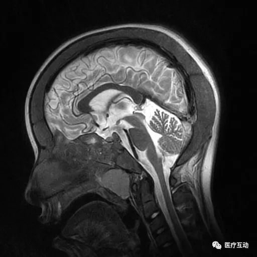影像PPT - 颅骨增厚影像表现-6 影像PPT - 颅骨增厚影像表现-6