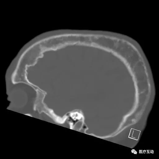 影像PPT - 颅骨增厚影像表现-8 影像PPT - 颅骨增厚影像表现-8