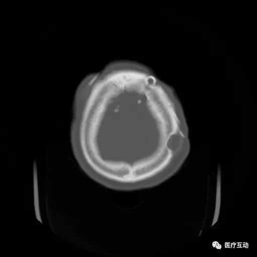影像PPT - 颅骨增厚影像表现-18 影像PPT - 颅骨增厚影像表现-18