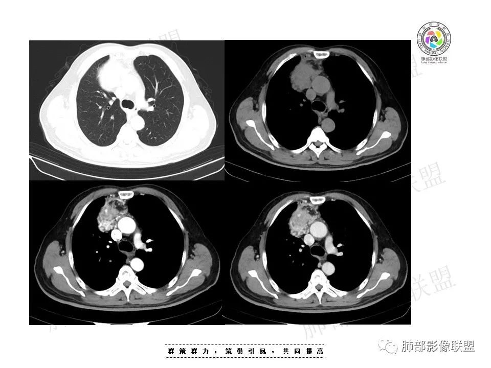 影像PPT - 【病例】前纵隔肿块—神经内分泌肿瘤1例-3 影像PPT - 【病例】前纵隔肿块—神经内分泌肿瘤1例-3