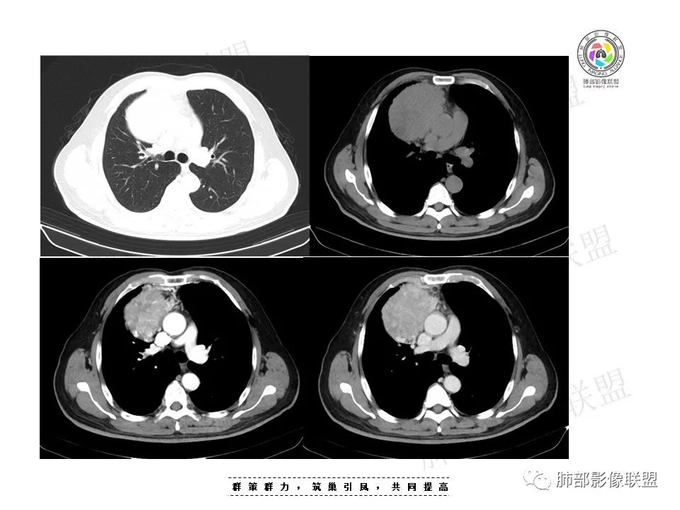 影像PPT - 【病例】前纵隔肿块—神经内分泌肿瘤1例-4 影像PPT - 【病例】前纵隔肿块—神经内分泌肿瘤1例-4