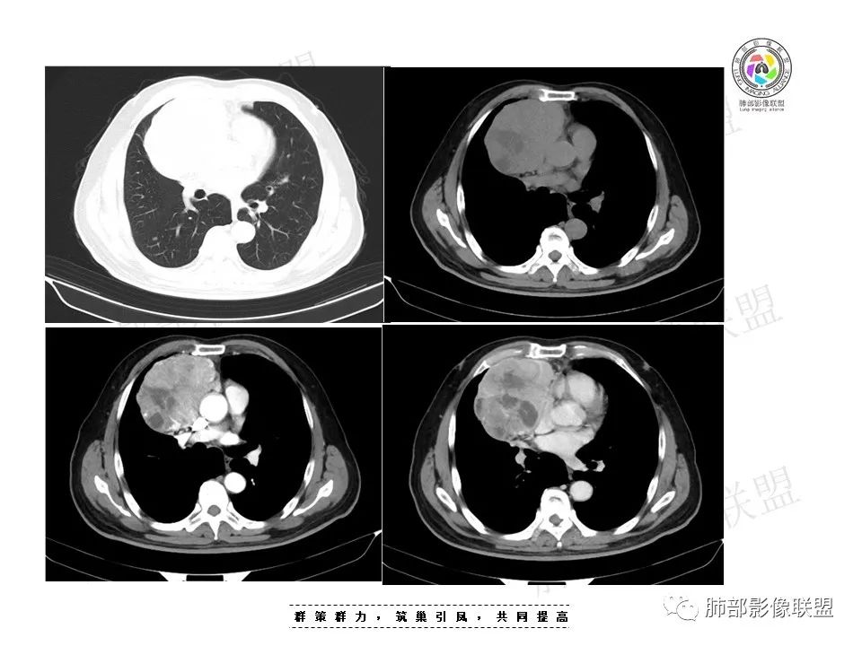 影像PPT - 【病例】前纵隔肿块—神经内分泌肿瘤1例-6 影像PPT - 【病例】前纵隔肿块—神经内分泌肿瘤1例-6