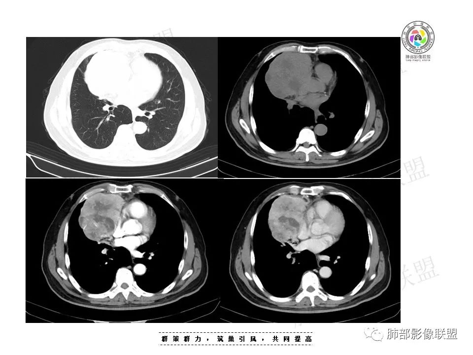 影像PPT - 【病例】前纵隔肿块—神经内分泌肿瘤1例-7 影像PPT - 【病例】前纵隔肿块—神经内分泌肿瘤1例-7