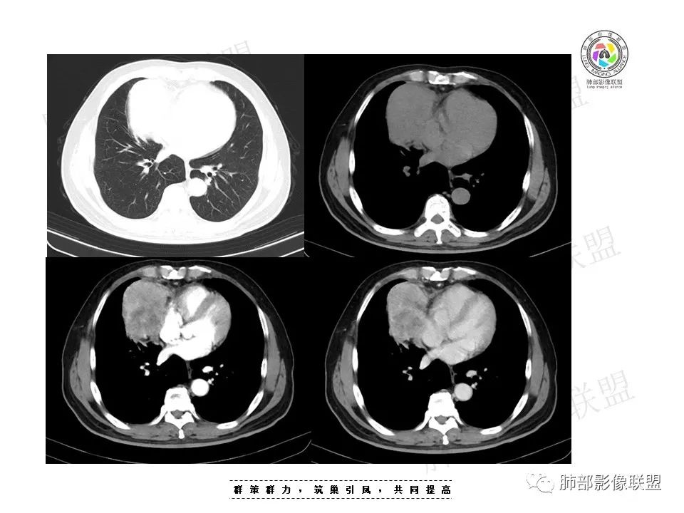 影像PPT - 【病例】前纵隔肿块—神经内分泌肿瘤1例-8 影像PPT - 【病例】前纵隔肿块—神经内分泌肿瘤1例-8