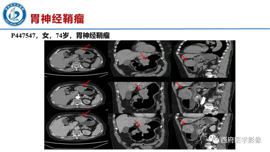 影像PPT - 【病例】胃神经鞘瘤1例CT影像-12