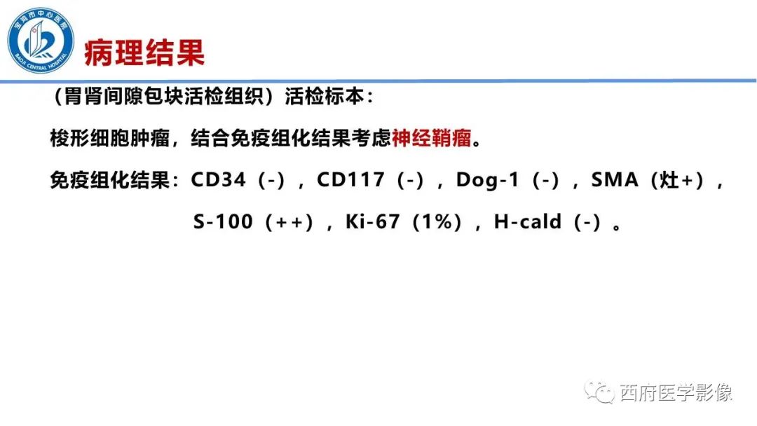 影像PPT - 【病例】胃神经鞘瘤1例CT影像-10
