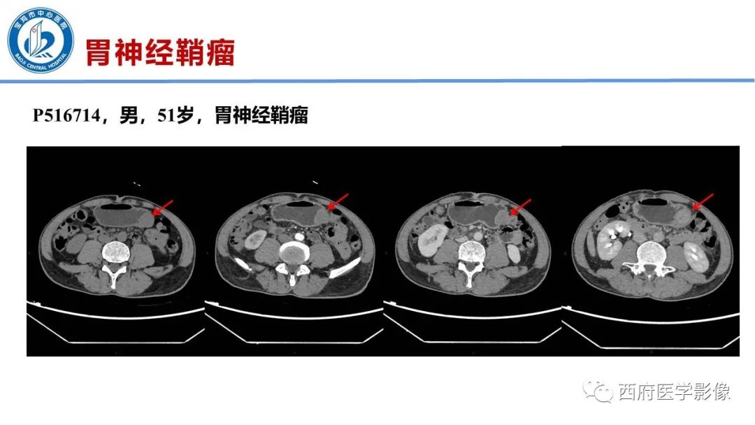 影像PPT - 【病例】胃神经鞘瘤1例CT影像-13
