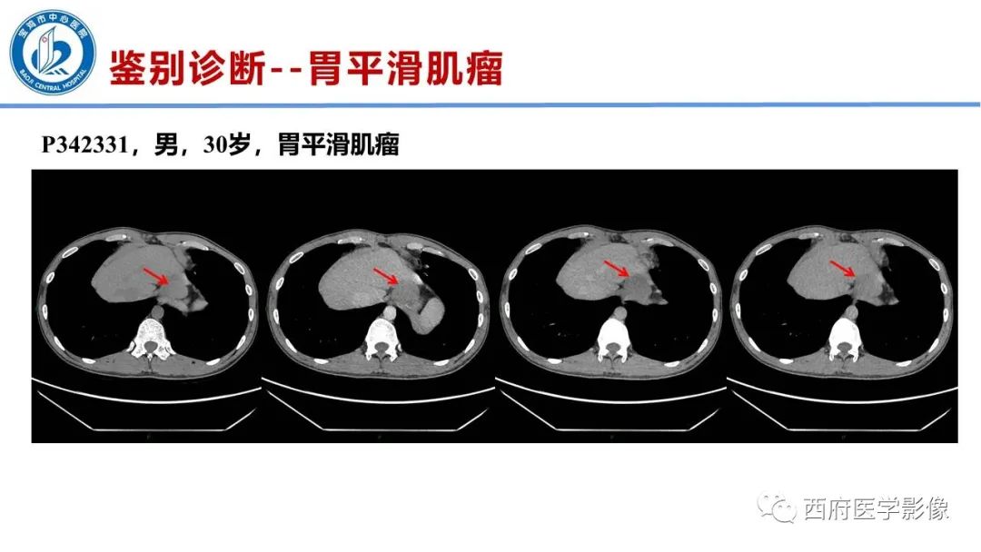 影像PPT - 【病例】胃神经鞘瘤1例CT影像-17