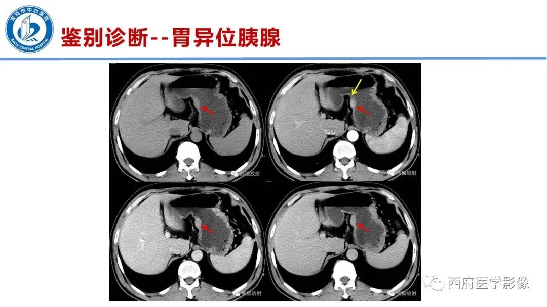 影像PPT - 【病例】胃神经鞘瘤1例CT影像-19