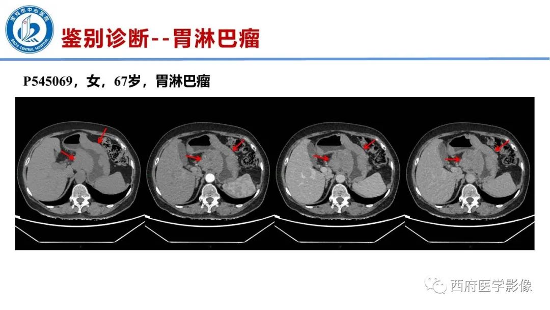 影像PPT - 【病例】胃神经鞘瘤1例CT影像-22