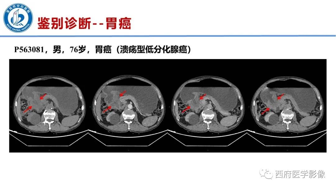 影像PPT - 【病例】胃神经鞘瘤1例CT影像-24