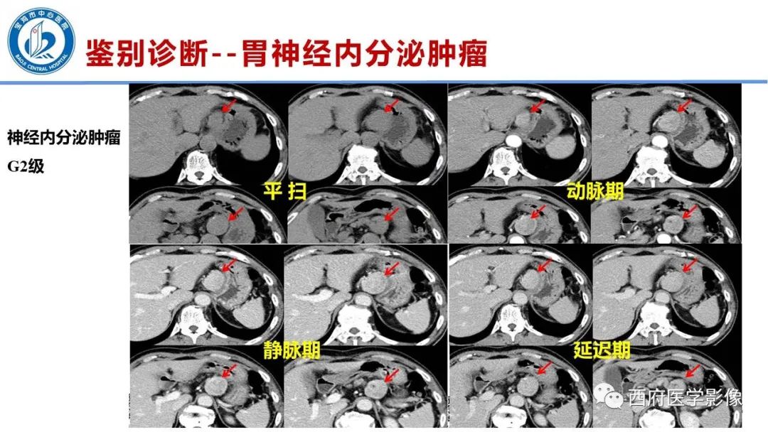 影像PPT - 【病例】胃神经鞘瘤1例CT影像-27