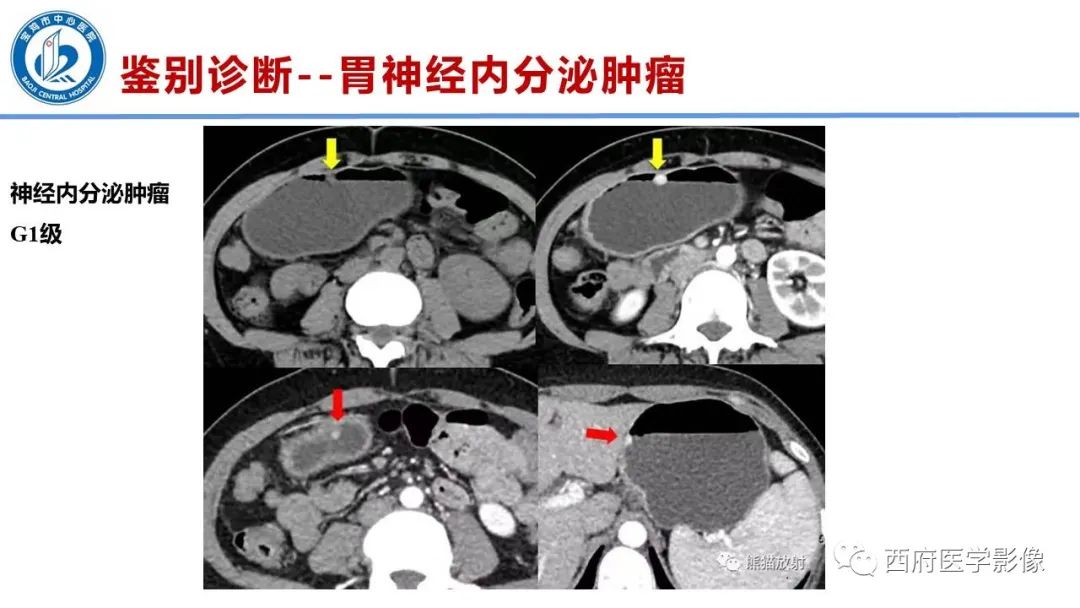 影像PPT - 【病例】胃神经鞘瘤1例CT影像-26