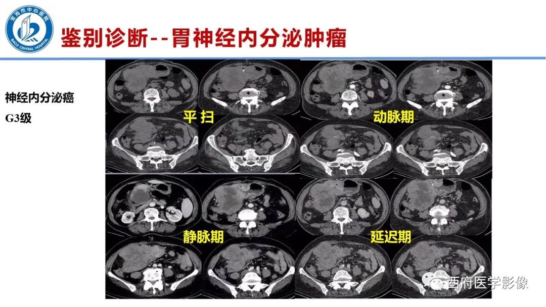 影像PPT - 【病例】胃神经鞘瘤1例CT影像-28