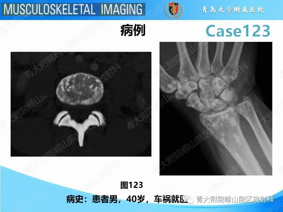 影像PPT - 【PPT】骨斑点症-2
