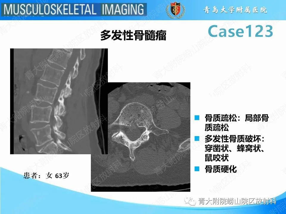 影像PPT - 【PPT】骨斑点症-9