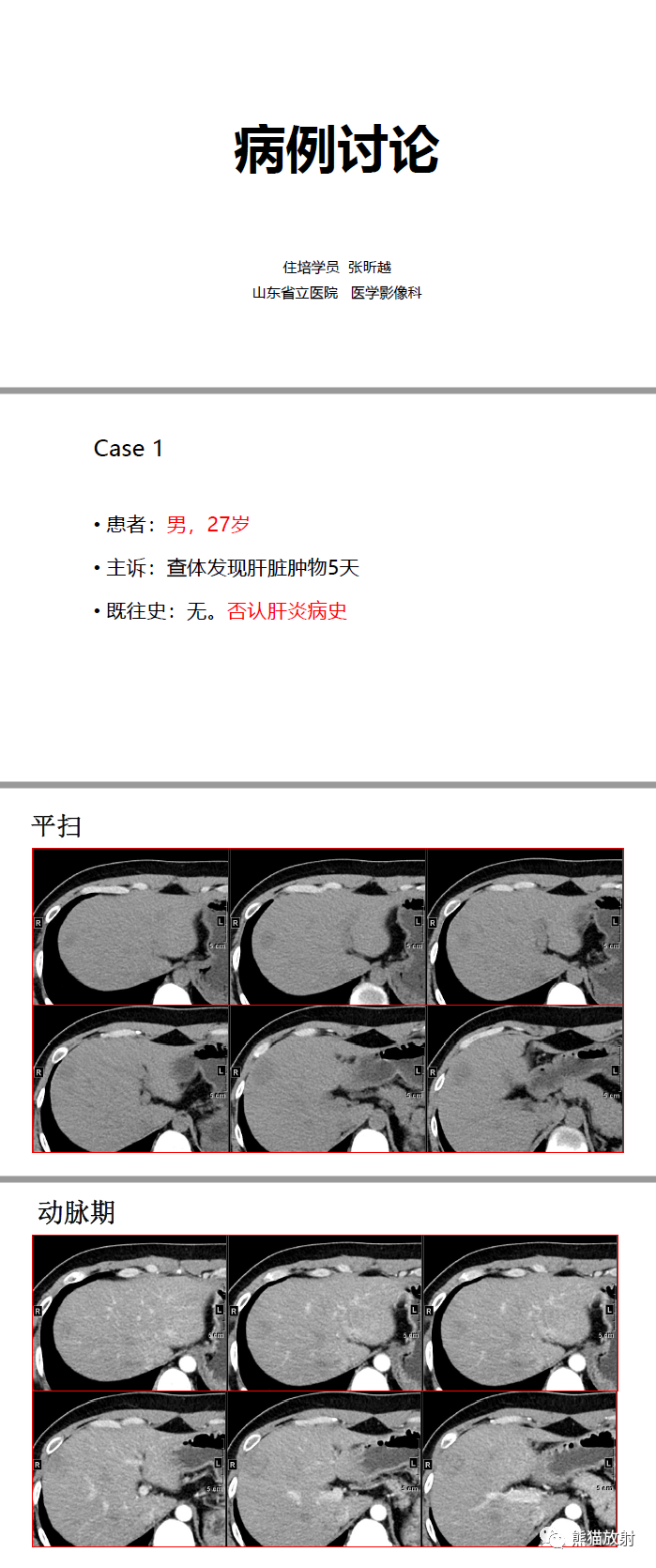 影像PPT - 【病例】肝脏炎性假瘤-1