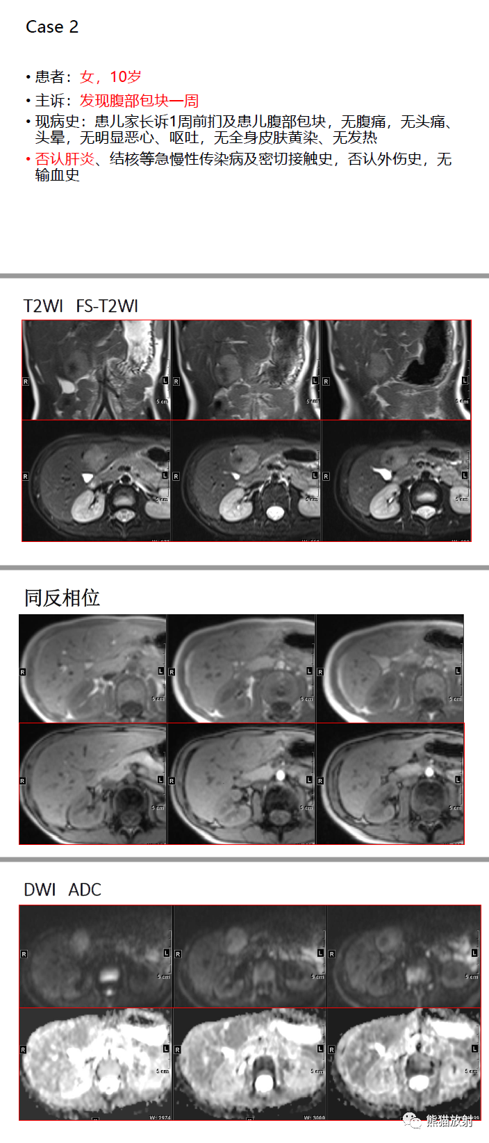 影像PPT - 【病例】肝脏炎性假瘤-7