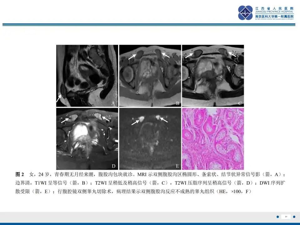 影像PPT - 【PPT】MRKH综合征-23