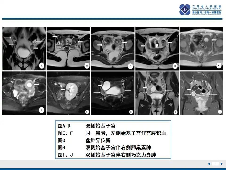 影像PPT - 【PPT】MRKH综合征-20