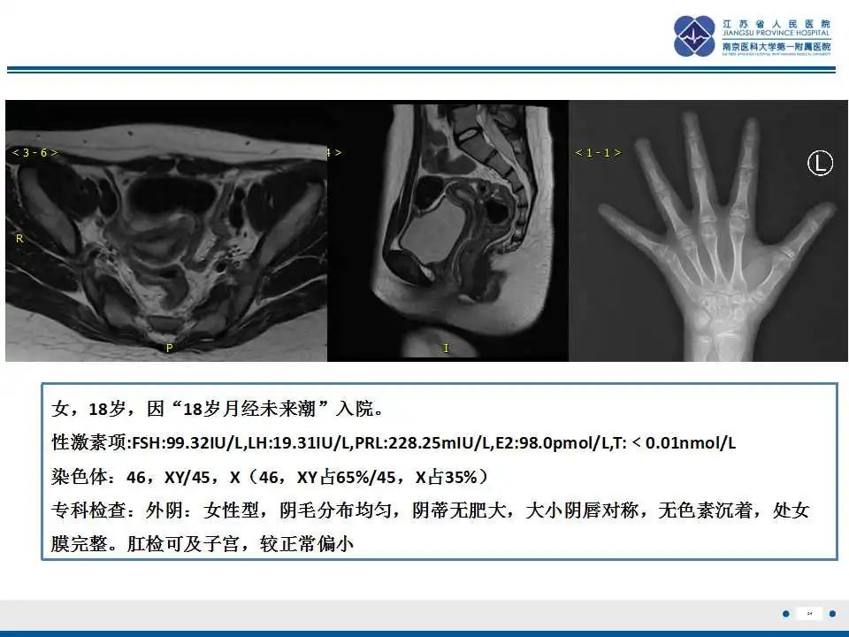 影像PPT - 【PPT】MRKH综合征-26