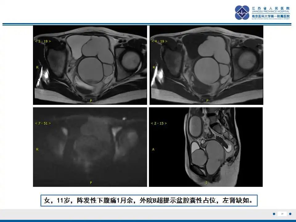 影像PPT - 【PPT】MRKH综合征-28