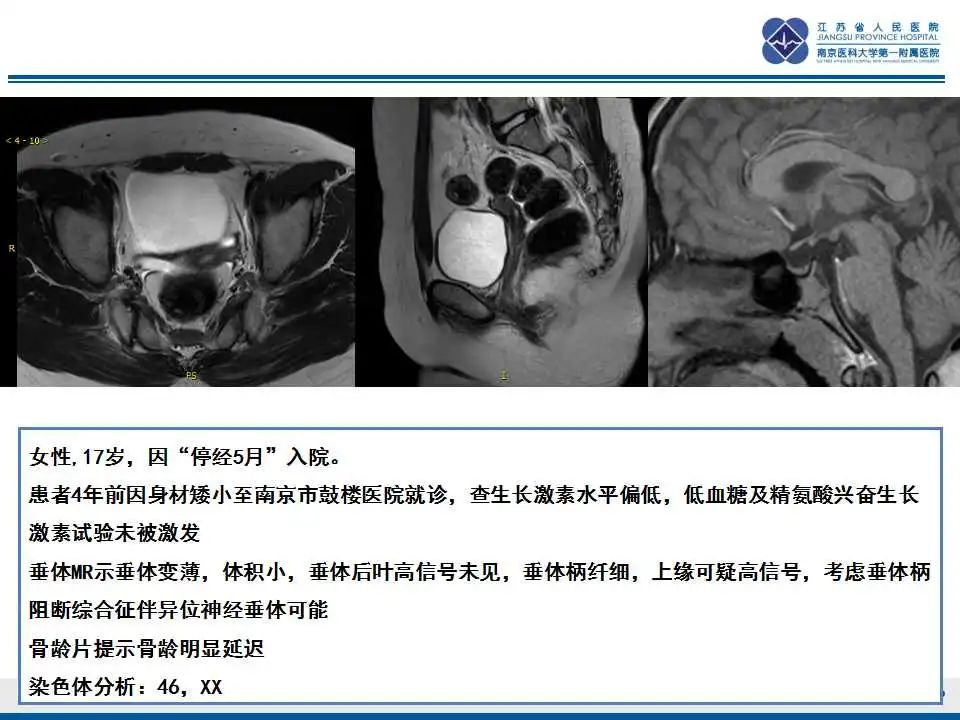 影像PPT - 【PPT】MRKH综合征-30