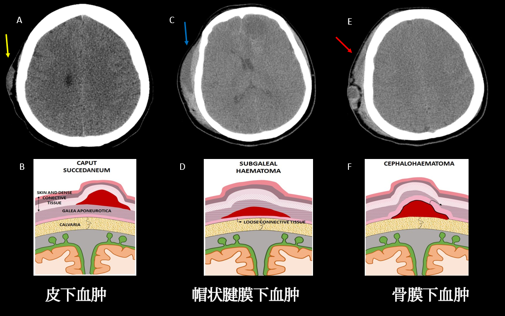 影像PPT - 头皮和颅骨病变的影像学特点-20