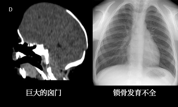 影像PPT - 头皮和颅骨病变的影像学特点-19