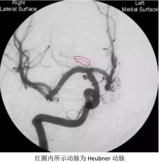 影像PPT - 大脑前动脉的分段图解-11 影像PPT - 大脑前动脉的分段图解-11